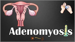 Adenomyosis  Definition Causes Risk Factors Signs amp Symptoms Diagnosis amp Treatment [upl. by Anyehs]