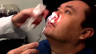 Doyle splint removal after sinus surgery [upl. by Mirelle]