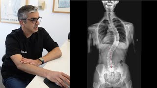 Severe Scoliosis Evaluation amp Treatment DrRahim Chiropractic [upl. by Ennairam]