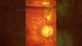 Residual C3F8 bubble 6 weeks after retinal detachment surgery  shorts [upl. by Gualterio]