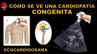 Persistencia del Conducto Arterioso  Ecocardiograma [upl. by Hilten964]