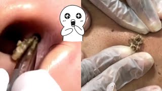 Ultimate Compilation Satisfying Blackhead Removal and Acne Treatment Highlights [upl. by Aceber15]