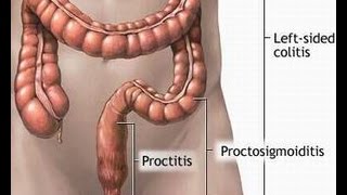 Treatment of Proctitis [upl. by Mou]