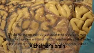 Dissectie hersenen normaal en Alzheimer [upl. by Ythomit]