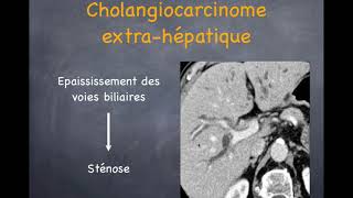 Tumeurs du foie  Malignes  3 Cholangiocarcinome [upl. by Albertina]