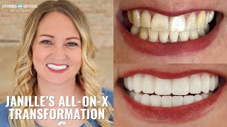 AllonX Smile Transformation Janille’s Journey to a PainFree Smile [upl. by Richmal]