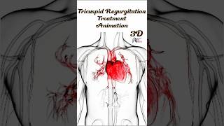 Tricuspid Regurgitation Treatment Animation medical animation 3d short [upl. by Enale79]