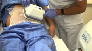 Adipolysis assisted by freezing cooltech procedure  cocoon medical [upl. by Relda]