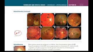 Retinal disorders  Neurology  33  First Aid USMLE in UrduHindi [upl. by Mignonne]