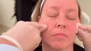 BaseLift™ Non Surgical Facelift by Dr Stephen Bracci [upl. by Eiddet750]