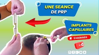 Une Seance De PRP  Implants Capillaires  Renaissance Clinique [upl. by Assela407]