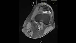 Prepatella bursitis with bursal wall thickening [upl. by Nolrev]