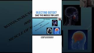 Injecting Botox Save THIS Muscle for Last [upl. by Madlen]