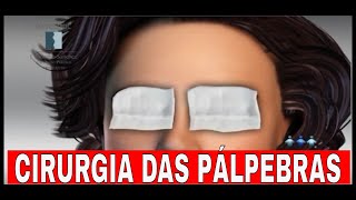 CIRURGIA DAS PÁLPEBRAS  Tudo que você precisa saber  Cirurgia Plástica [upl. by Colvin361]