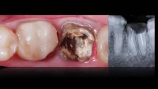 Tooth autotransplantation [upl. by Oswin471]