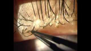 Demodex Blepharitis  Is it for real [upl. by Dafodil733]