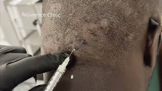 Intralesional Steroid Injections for Acne Keloidalis Nuchae rejuvenceclinic91 [upl. by Krissy]