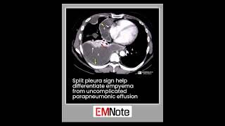 Split Pleura Sign radiology doctor medical [upl. by Arreis]