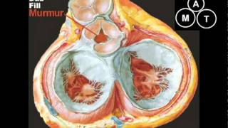 Aortic Regurgitation Murmur [upl. by Sirtimid]