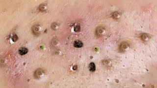 Satisfying big blackhead removal  Pimple popping 120 [upl. by Hsirrap]