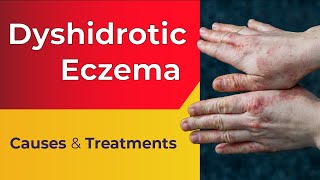 What is Dyshidrotic Eczema  Overview Causes Treatments [upl. by Sage94]