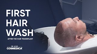 First Hair Wash After the Hair Transplant [upl. by Anaiv]