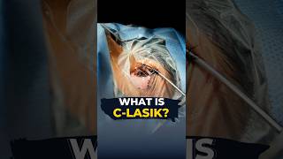 Do You Know What Is CLasik I CLasik Live Surgery [upl. by Kcirtemed]