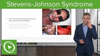 StevensJohnson Syndrome – Dermatology  Lecturio [upl. by Felton]