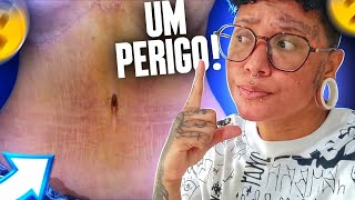 QUEM FEZ ABDOMINOPLASTIA PODE COLOCAR PIERCING NO UMBIGO [upl. by Kuehn271]