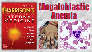 MEGALOBLASTIC ANEMIA  Causes  Clinical Features  Diagnosis  Treatment  Harrison [upl. by Juliette]