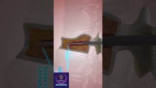 Kyphoplasty Surgery Procedure [upl. by Reiser513]