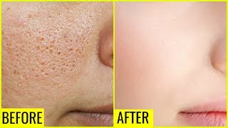 How to Get Rid of Large OPEN PORES Permanently  Anaysa [upl. by Booma]