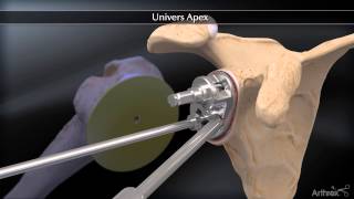 Apex Total Shoulder Arthroplasty Systems [upl. by Resaec101]