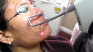 Laser Hair Removal with Fotona Laser in Los Angeles Orange County and San Gabriel Valley [upl. by Elfreda787]