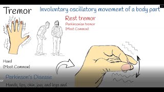 Stop your essential tremor best treatment for essential tremor [upl. by Emiaj225]