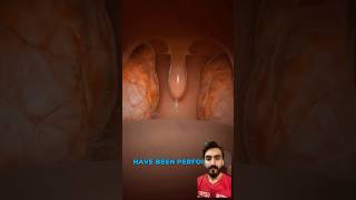 Tonsillectomy Explained 3D Animation [upl. by Ecam]