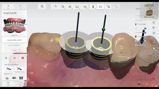 3Shape Implant Studio 2020 Detailed Workflow [upl. by Arik969]