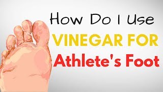 How Do I Use VINEGAR for Athletes Foot Treatment – 9 BEST Remedies [upl. by Esened]