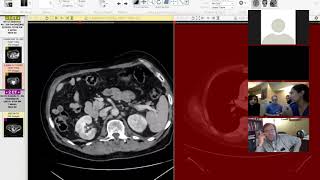 Renal manifestations of IGG4  Dr Nelly Tan [upl. by Banebrudge]