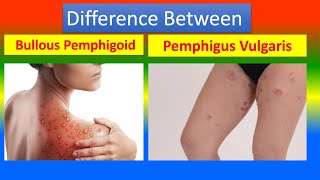 Difference Between Bullous Pemphigoid and Pemphigus Vulgaris [upl. by Ettelohcin]