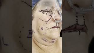 Facelift Blepharoplasty and Fat Transfer  Before surgery vs immediately after [upl. by Davidoff910]