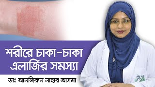 Hives  UrticariaCausesSymptomsTreatment  Skin Rash  এলার্জি থেকে মুক্তির উপায়  ত্বকে চুলকানি [upl. by Picardi712]