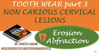 Tooth erosion Causes and treatment  Tooth Abfraction Non carious cervical lesions [upl. by Adle]