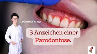 3 Anzeichen für Parodontose [upl. by Ataeb]