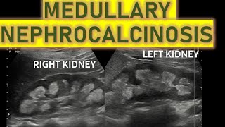 BILATERAL MEDULLARY NEPHROCALCINOSIS ON USG  And its causes [upl. by Charpentier233]