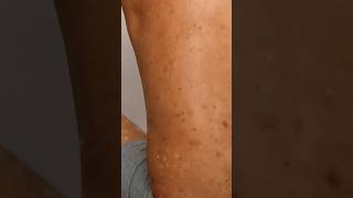 what causes This Skin Condition skincare skincareroutine viralshorts viralvideo skincondition [upl. by Yennor978]