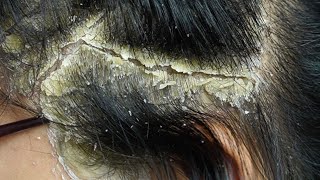 Dandruff scratching removal on head using black combing443 [upl. by Montague637]