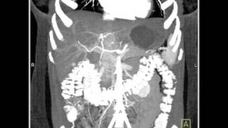 Abdomen Liver Focal Nodular Hyperplasia CT Angiography1 of 6 [upl. by Ellenohs]