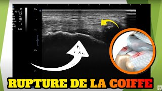 Echographie dune rupture de la coiffe des rotateurs [upl. by Belmonte]