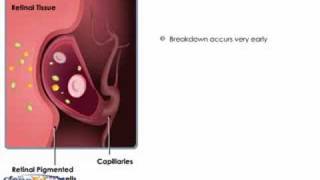 Breakdown of the BloodRetinal Barrier [upl. by Solange]